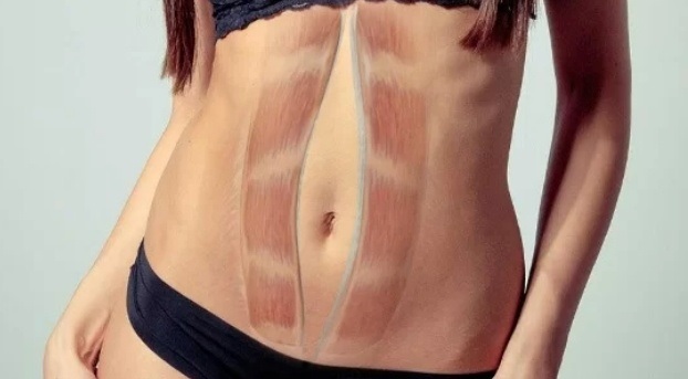 https://leleka-surgery.com.ua/abdominalna-hirurgija/diastaz-prjamih-m-jaziv-zhivota/